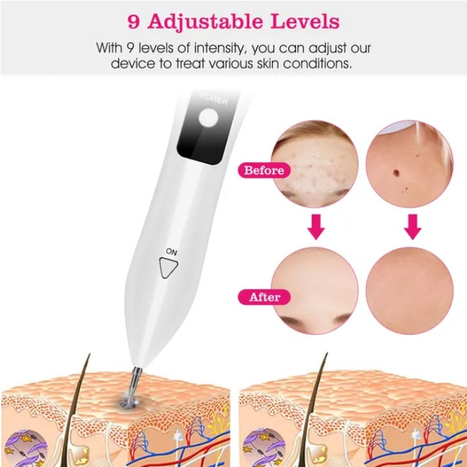 Portable Skin Tag Remover
